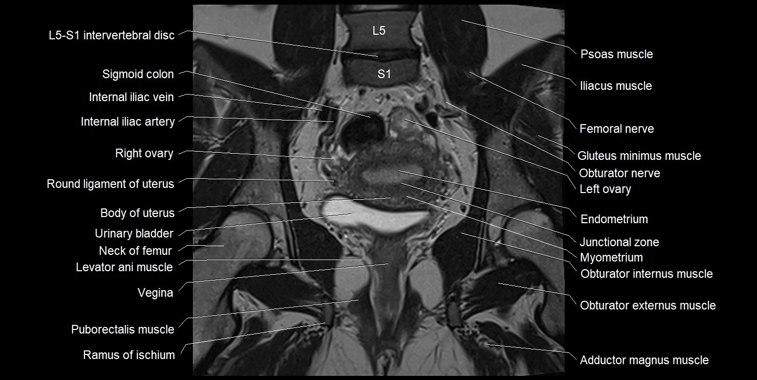 female pelvis coronal cross sectional anatomy image 19.webp